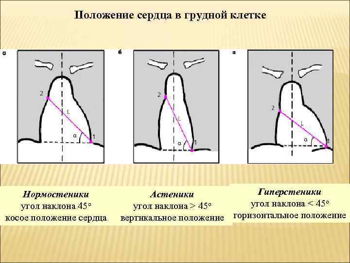 Положение сердца в грудной клетке Нормостеники угол наклона 45 о косое положение сердца Гиперстеники