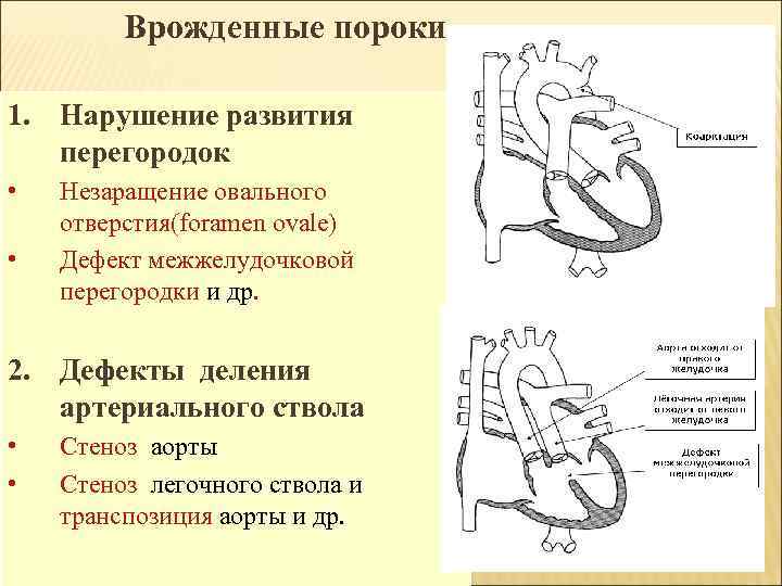 Врожденные пороки 1. Нарушение развития перегородок • • Незаращение овального отверстия(foramen ovale) Дефект межжелудочковой