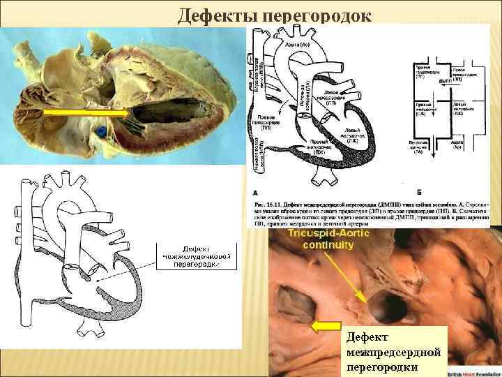 Дефекты перегородок Дефект межпредсердной перегородки 