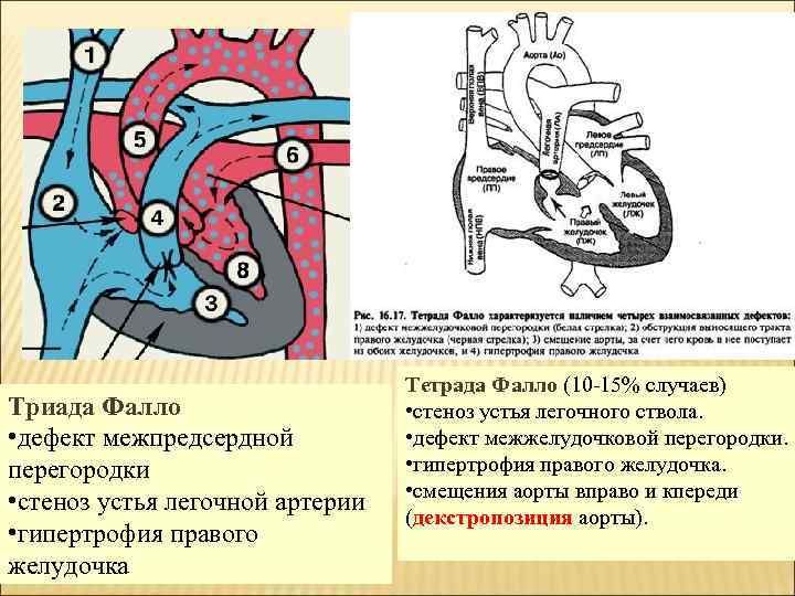 Триада Фалло • дефект межпредсердной перегородки • стеноз устья легочной артерии • гипертрофия правого