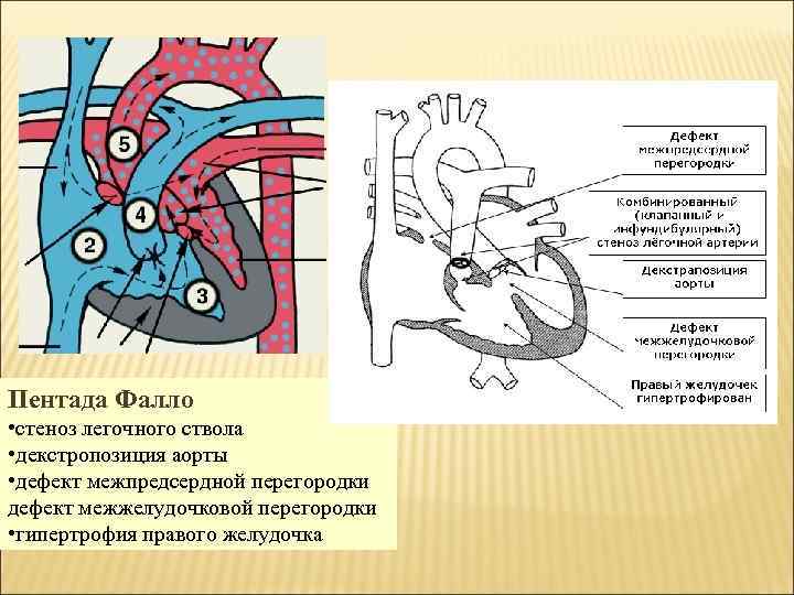 Пентада Фалло • стеноз легочного ствола • декстропозиция аорты • дефект межпредсердной перегородки дефект