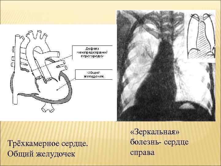 Трёхкамерное сердце. Общий желудочек «Зеркальная» болезнь- сердце справа 