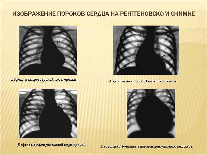 ИЗОБРАЖЕНИЕ ПОРОКОВ СЕРДЦА НА РЕНТГЕНОВСКОМ СНИМКЕ Дефект межпредсердной перегородки Дефект межжелудочковой перегородки Аортальный стеноз.