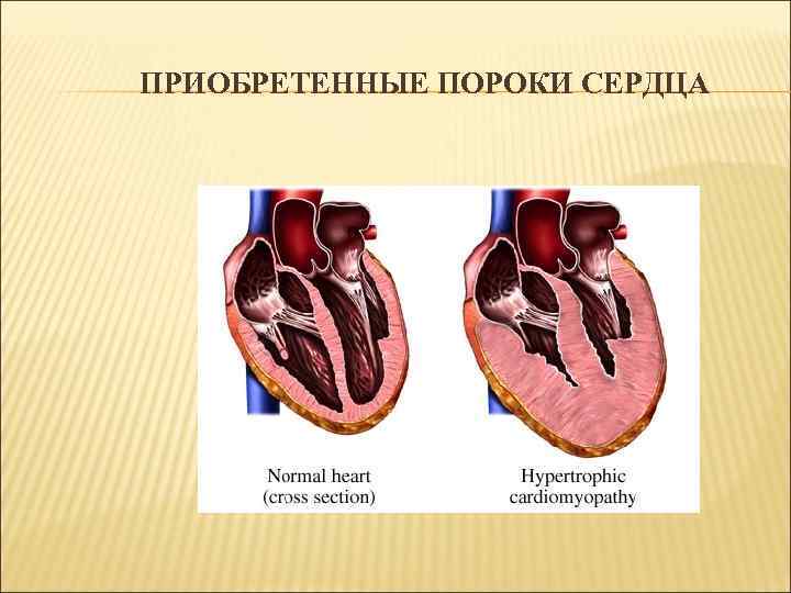 ПРИОБРЕТЕННЫЕ ПОРОКИ СЕРДЦА 