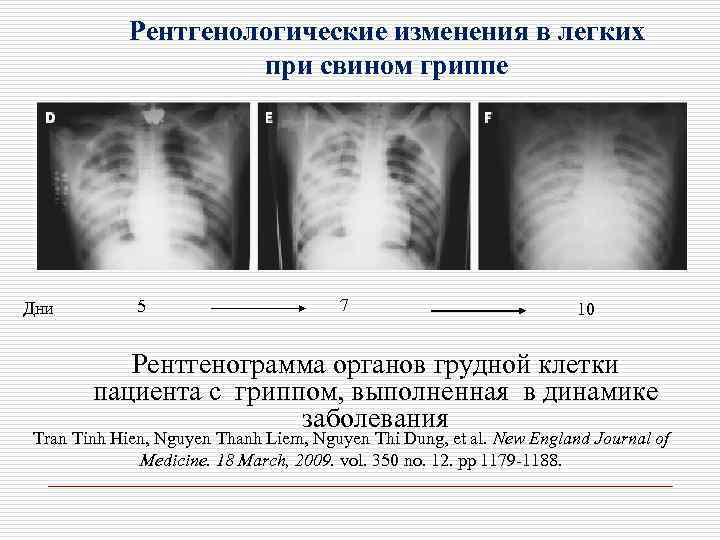 Рентгенологические изменения в легких при свином гриппе Дни 5 7 10 Рентгенограмма органов грудной