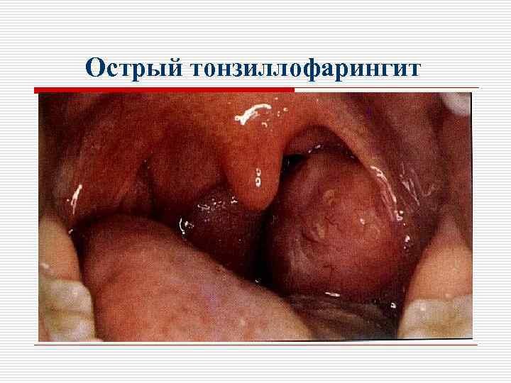 Острый тонзиллофарингит 
