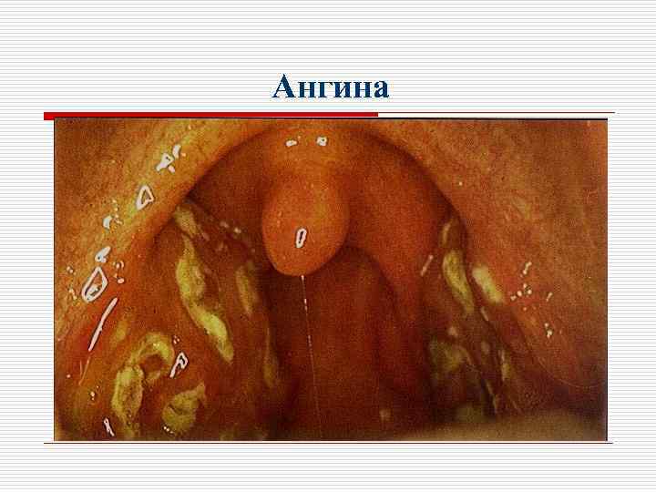 Ангина 