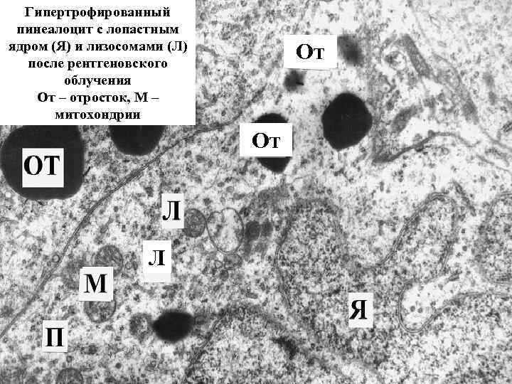 Гипертрофированный пинеалоцит с лопастным ядром (Я) и лизосомами (Л) после рентгеновского облучения От –
