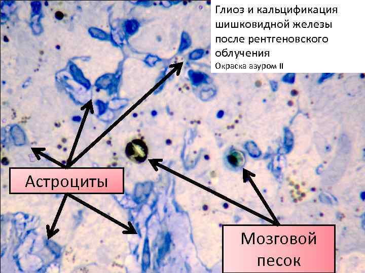 Глиоз и кальцификация шишковидной железы после рентгеновского облучения Окраска азуром II Астроциты Мозговой песок