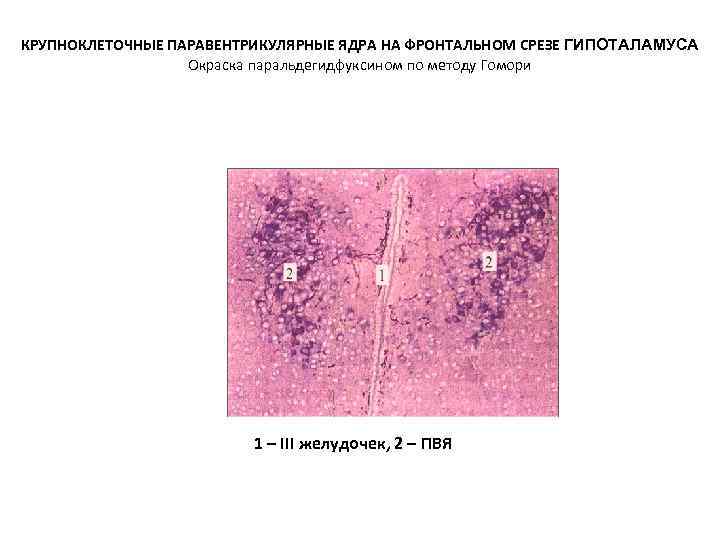 КРУПНОКЛЕТОЧНЫЕ ПАРАВЕНТРИКУЛЯРНЫЕ ЯДРА НА ФРОНТАЛЬНОМ СРЕЗЕ ГИПОТАЛАМУСА Окраска паральдегидфуксином по методу Гомори 1 –