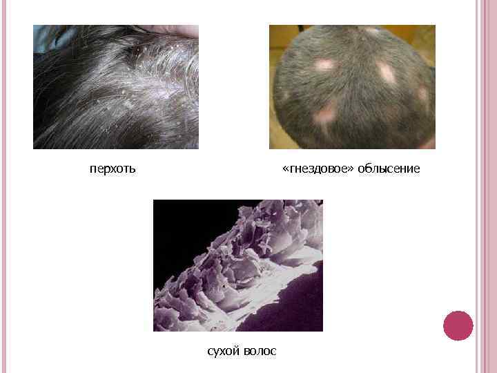 перхоть «гнездовое» облысение сухой волос 