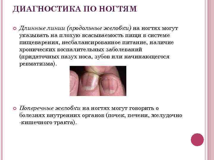 ДИАГНОСТИКА ПО НОГТЯМ Длинные линии (продольные желобки) на ногтях могут указывать на плохую всасываемость