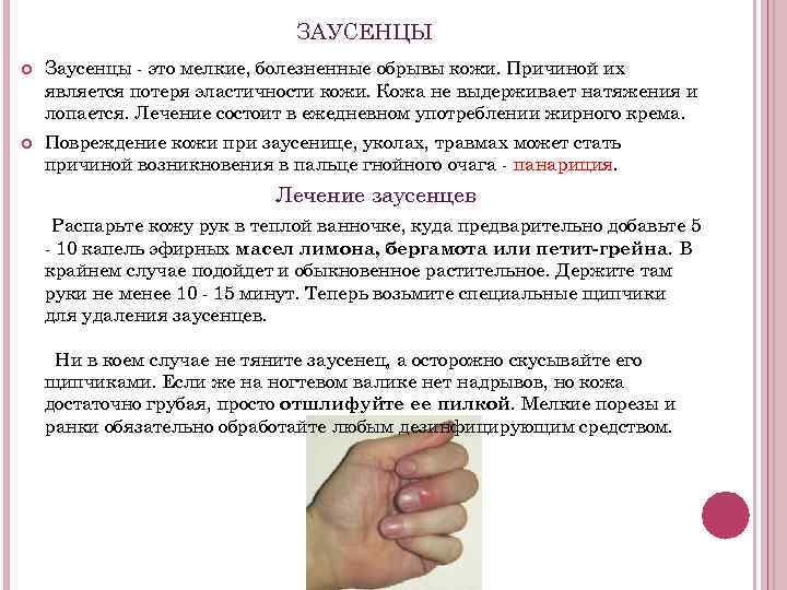 ЗАУСЕНЦЫ Заусенцы - это мелкие, болезненные обрывы кожи. Причиной их является потеря эластичности кожи.