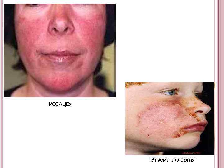 РОЗАЦЕЯ Экзема-аллергия 