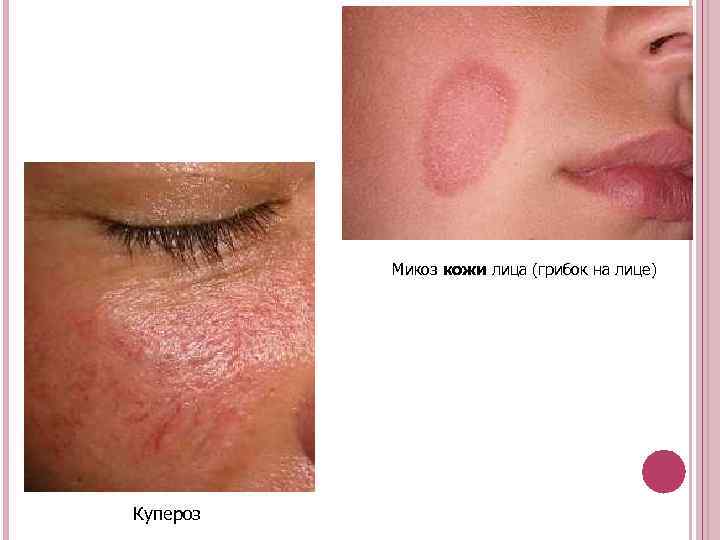 Микоз кожи лица (грибок на лице) Купероз 