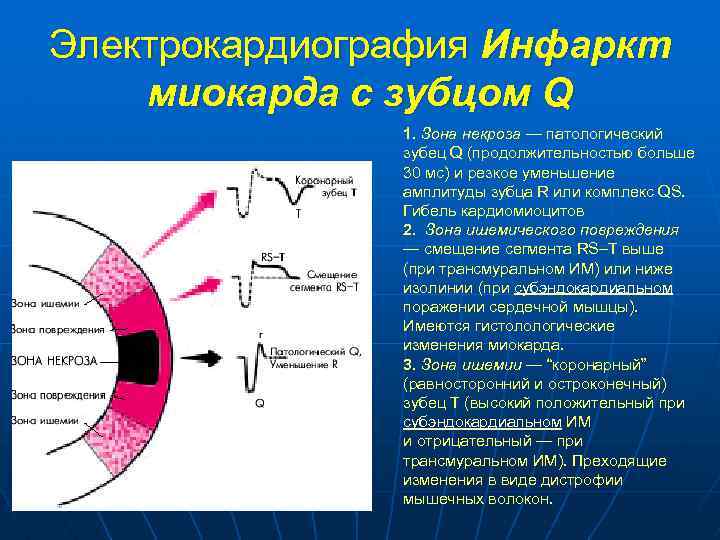 Электрокардиография Инфаркт миокарда с зубцом Q 1. Зона некроза — патологический зубец Q (продолжительностью