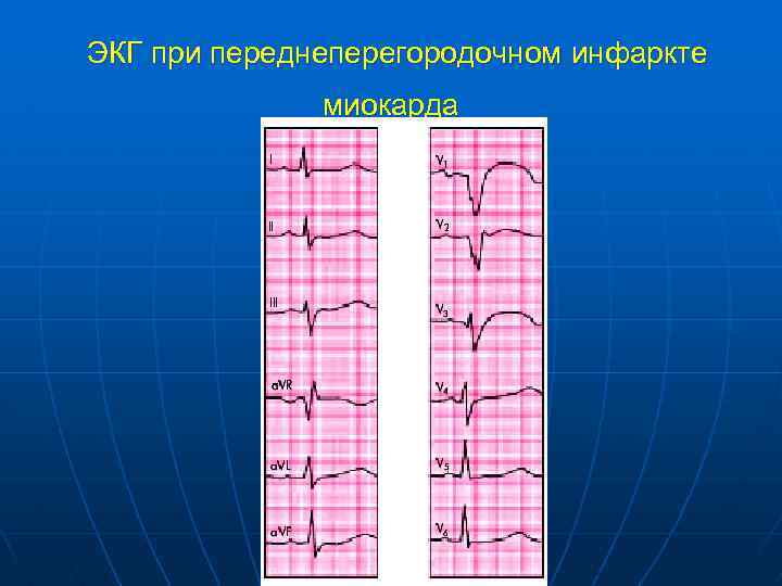  ЭКГ при переднеперегородочном инфаркте миокарда 