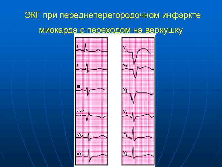  ЭКГ при переднеперегородочном инфаркте миокарда с переходом на верхушку 