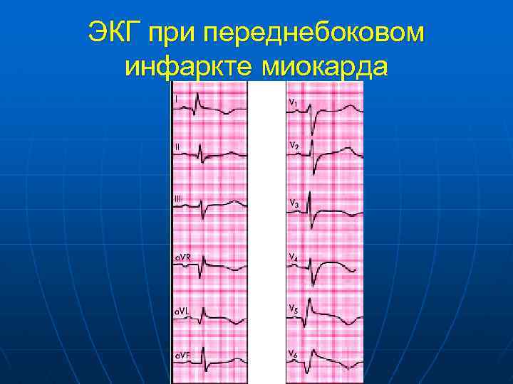 ЭКГ при переднебоковом инфаркте миокарда 