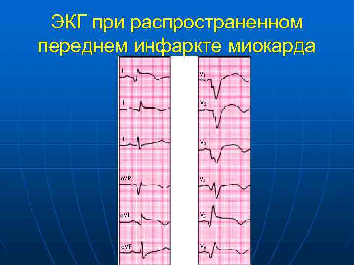 ЭКГ при распространенном переднем инфаркте миокарда 