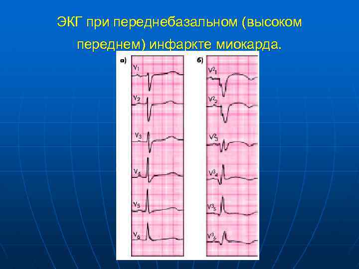 ЭКГ при переднебазальном (высоком переднем) инфаркте миокарда. 