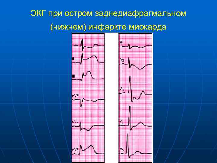 ЭКГ при остром заднедиафрагмальном (нижнем) инфаркте миокарда 