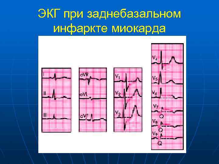 ЭКГ при заднебазальном инфаркте миокарда 