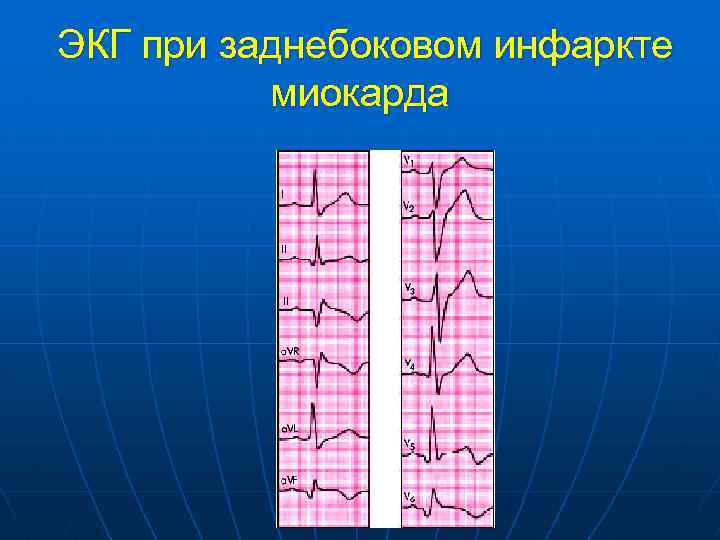  ЭКГ при заднебоковом инфаркте миокарда 