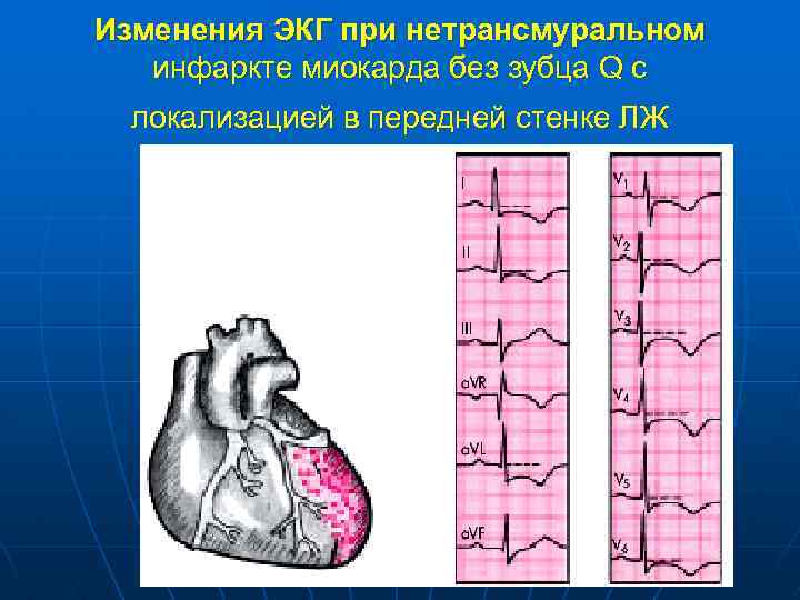 Изменения ЭКГ при нетрансмуральном инфаркте миокарда без зубца Q с локализацией в передней стенке