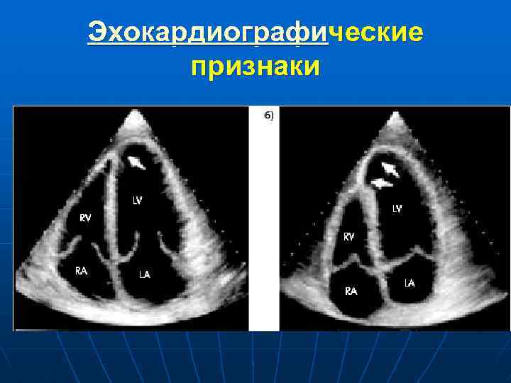 Эхокардиографические признаки 