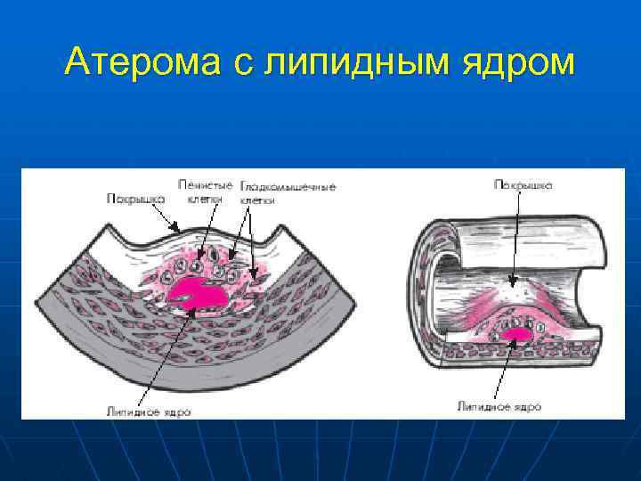 Атерома с липидным ядром 