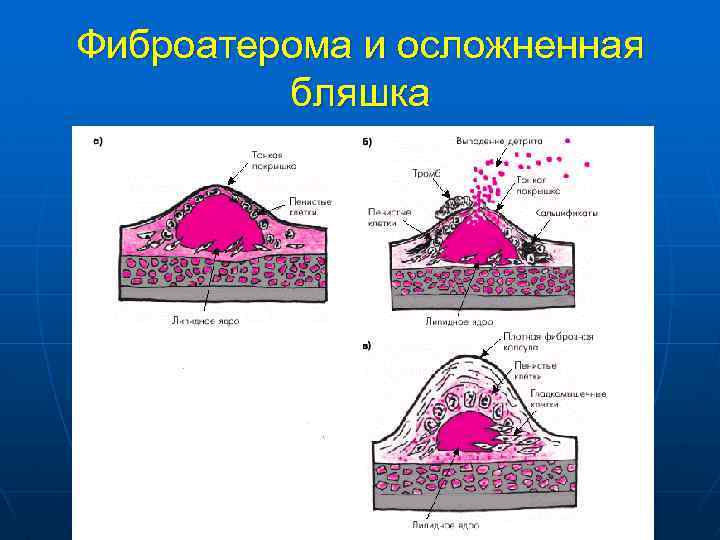 Фиброатерома и осложненная бляшка 