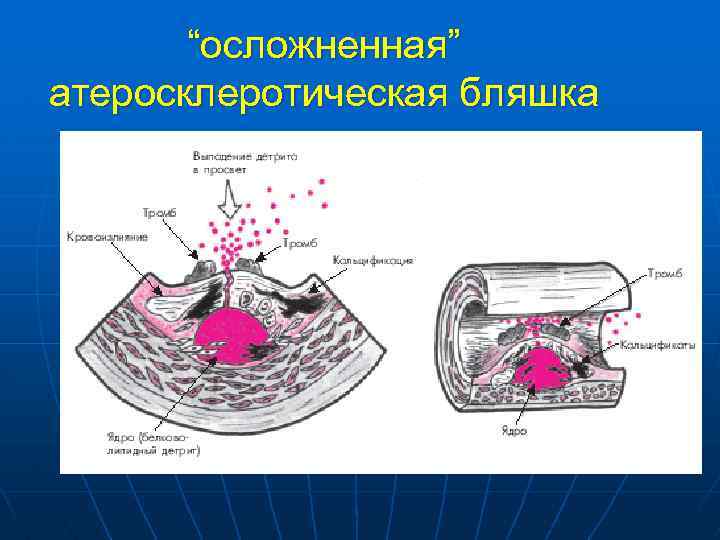 “осложненная” атеросклеротическая бляшка 