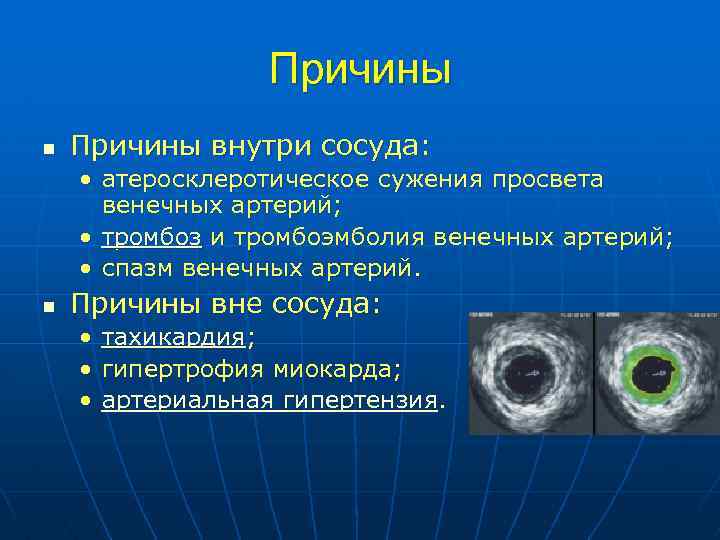 Причины n Причины внутри сосуда: • атеросклеротическое сужения просвета венечных артерий; • тромбоз и