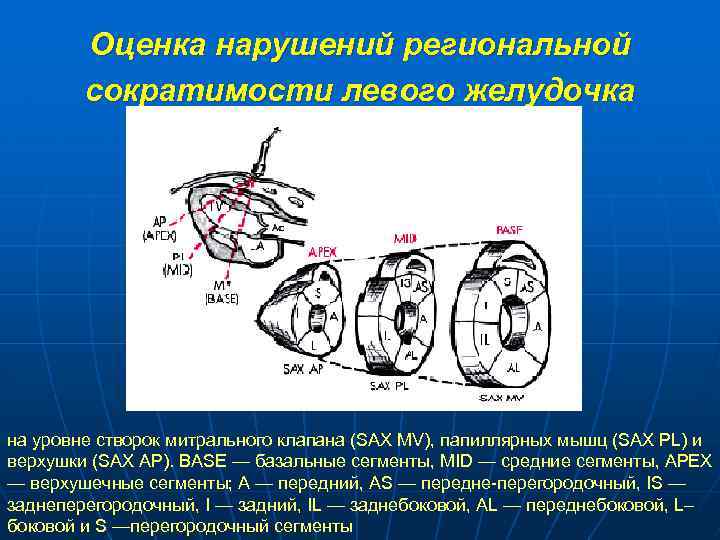 Оценка нарушений региональной сократимости левого желудочка на уровне створок митрального клапана (SАХ МV), папиллярных