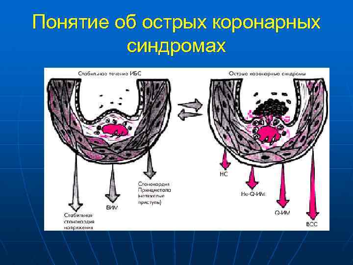 Понятие об острых коронарных синдромах 