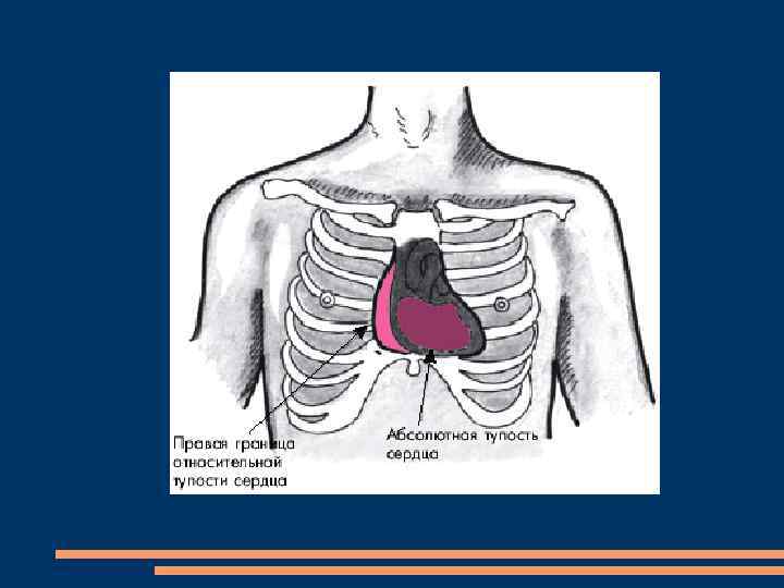 Сердечный относительно. Расширение границ относительной сердечной тупости. Расширение абсолютной тупости сердца. Граница относительной тупости сердца расширена при. Увеличение границ сердца.