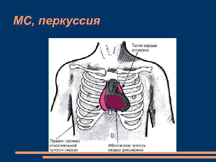 МС, перкуссия 