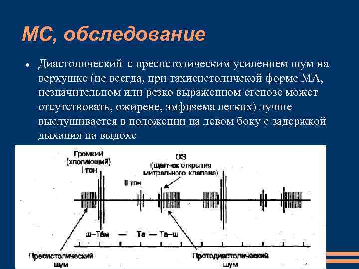 МС, обследование Диастолический с пресистолическим усилением шум на верхушке (не всегда, при тахисистоличекой форме