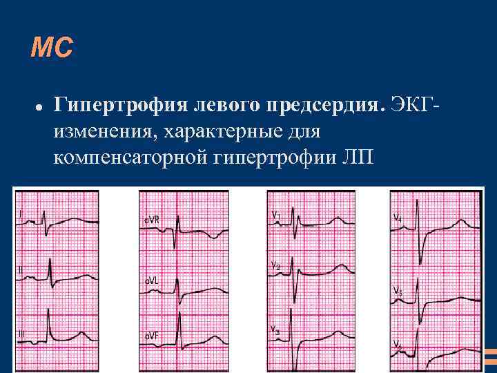 МС Гипертрофия левого предсердия. ЭКГизменения, характерные для компенсаторной гипертрофии ЛП 