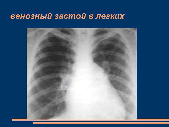 Венозный застой. Венозный застой МКК 1 степени. Венозный застой рентген. Легочно венозный застой. Венозный застой в легких рентген.