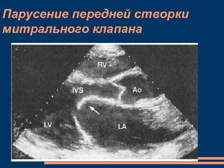 Парусение передней створки митрального клапана 