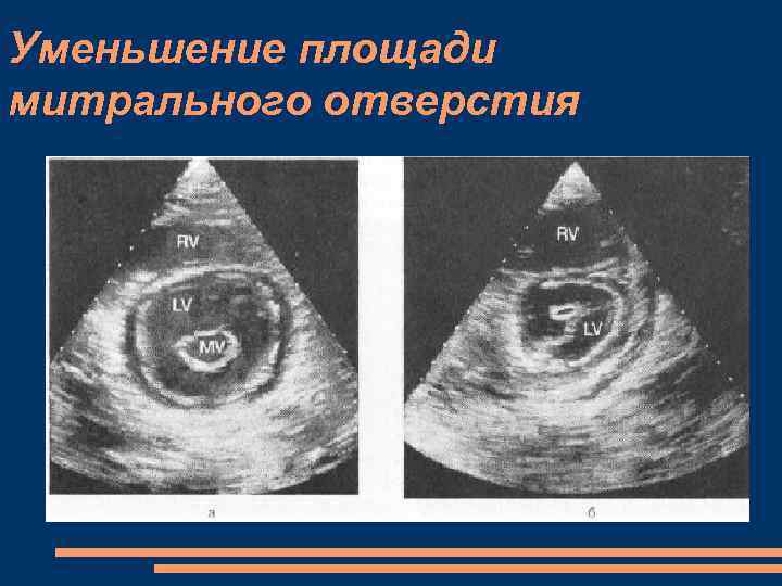 Уменьшение площади митрального отверстия 