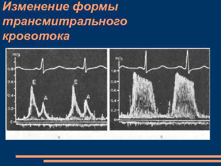 Изменение формы трансмитрального кровотока 