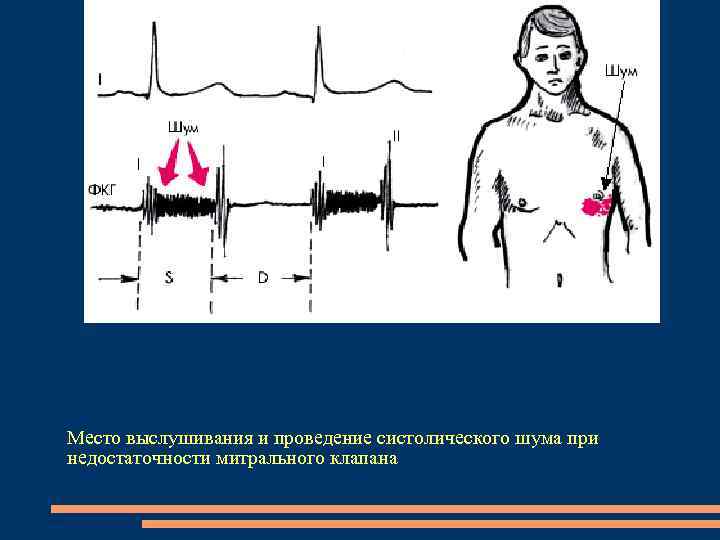 Место выслушивания и проведение систолического шума при недостаточности митрального клапана 