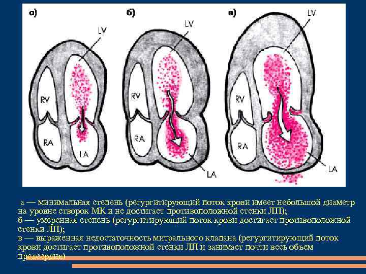  а — минимальная степень (регургитирующий поток крови имеет небольшой диаметр на уровне створок
