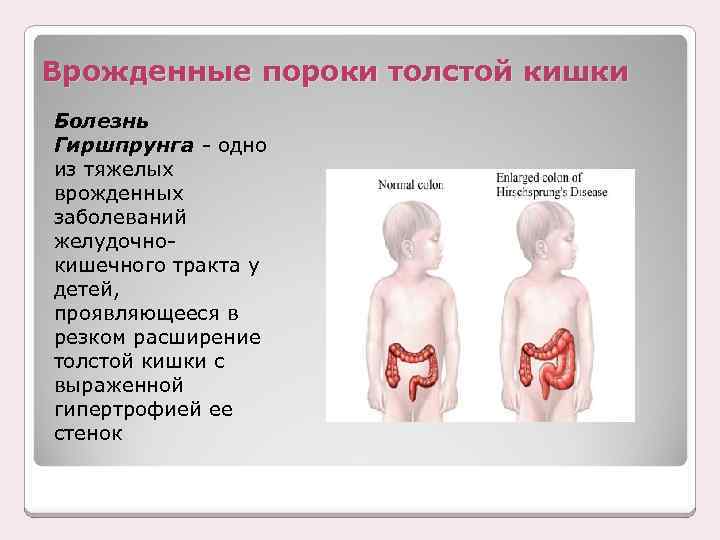 Врожденные пороки толстой кишки Болезнь Гиршпрунга - одно из тяжелых врожденных заболеваний желудочнокишечного тракта