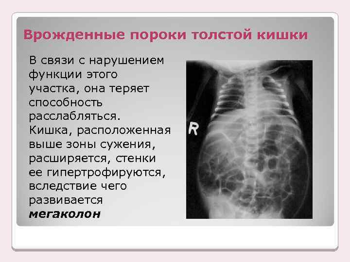 Врожденные пороки толстой кишки В связи с нарушением функции этого участка, она теряет способность