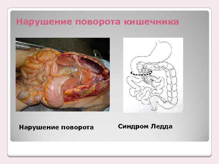 Нарушение поворота кишечника Нарушение поворота Синдром Ледда 