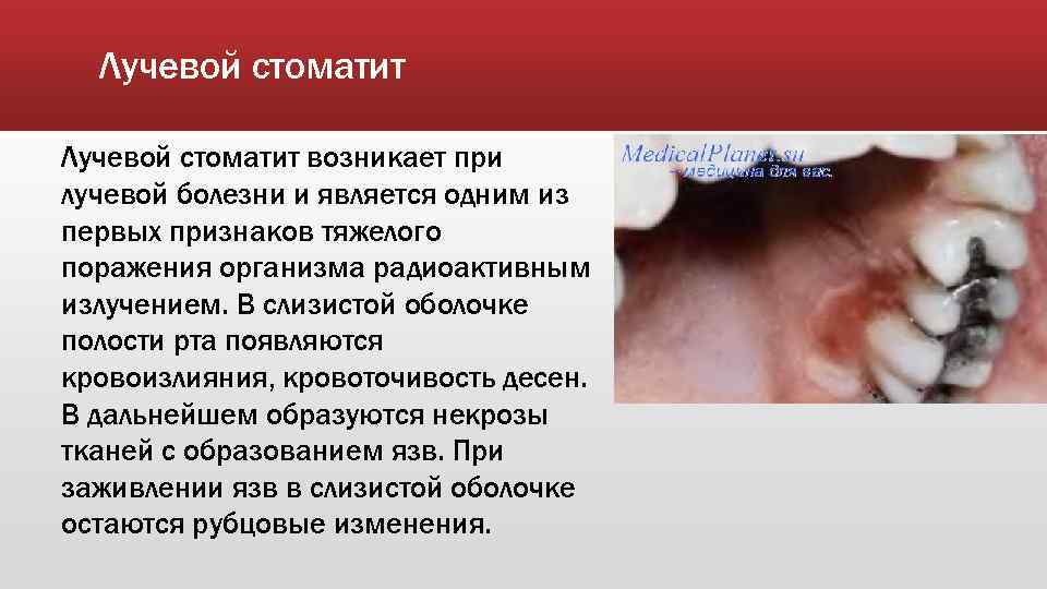 Лучевой стоматит возникает при лучевой болезни и является одним из первых признаков тяжелого поражения